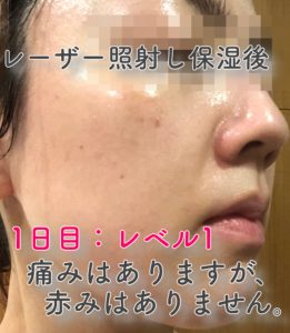 わずか1日2分 美容レーザーを自宅で簡単に サロンに行くより断然安い コスパの良い家庭用美顔器をご紹介 毎日好きなコト